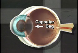 Graphic of capsular bag